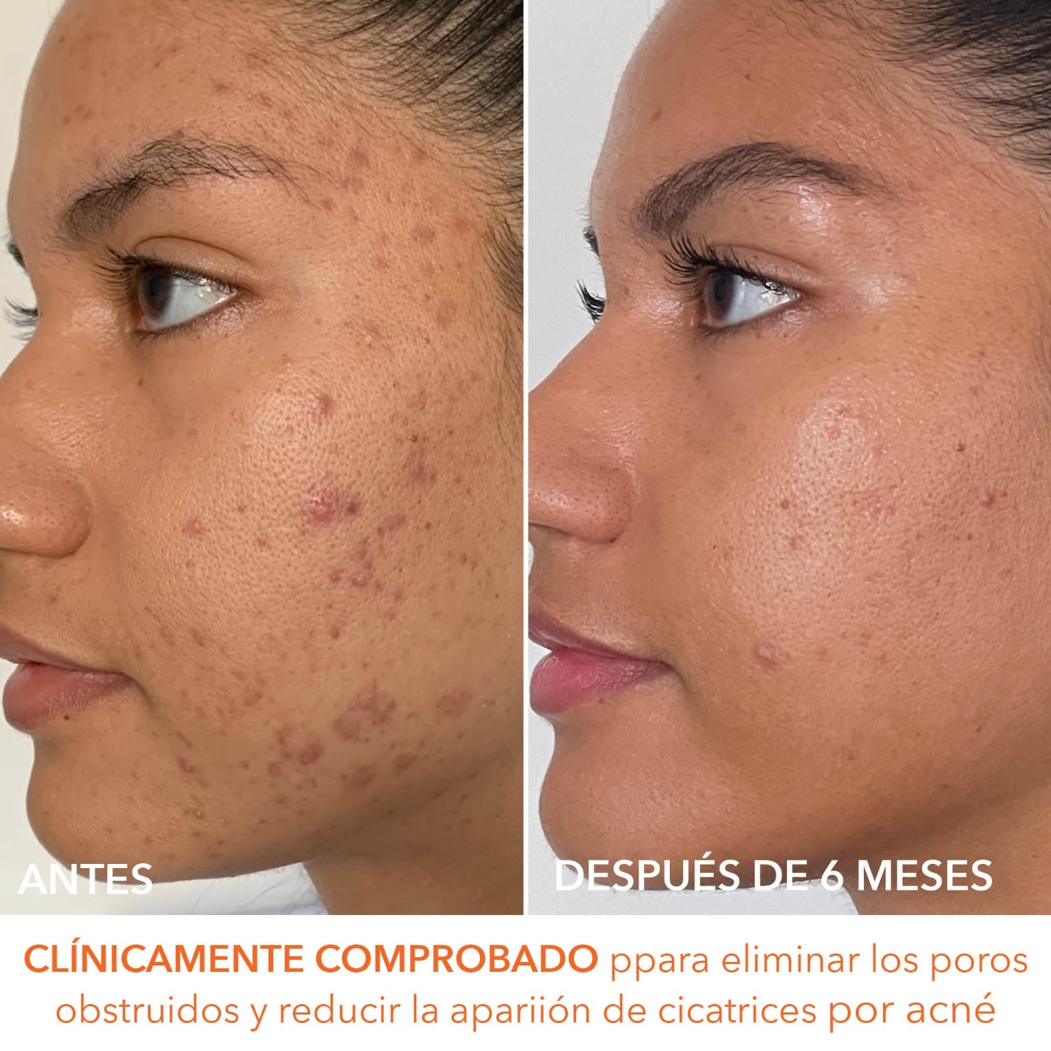 ALPHA BETA EXTRA STRENGTH DAILY PEEL  (ALMOHADILLAS EXFOLIANTES DIARIAS EXTRAFUERTES)